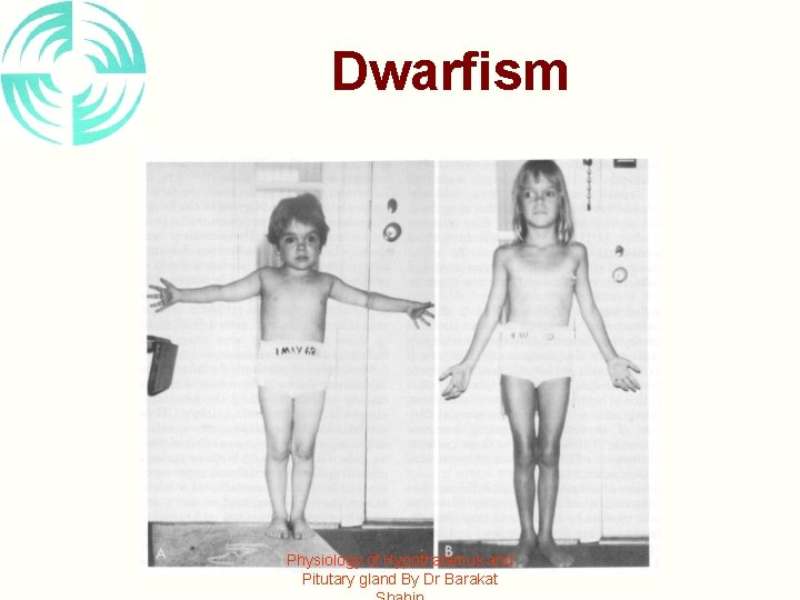 Dwarfism Physiology of Hypothalamus and Pitutary gland By Dr Barakat 