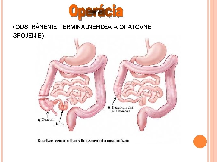 (ODSTRÁNENIE TERMINÁLNEHO ILEA A OPÄTOVNÉ SPOJENIE) 