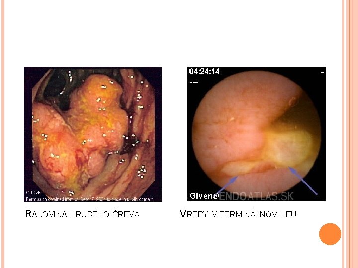 RAKOVINA HRUBÉHO ČREVA VREDY V TERMINÁLNOM ILEU 