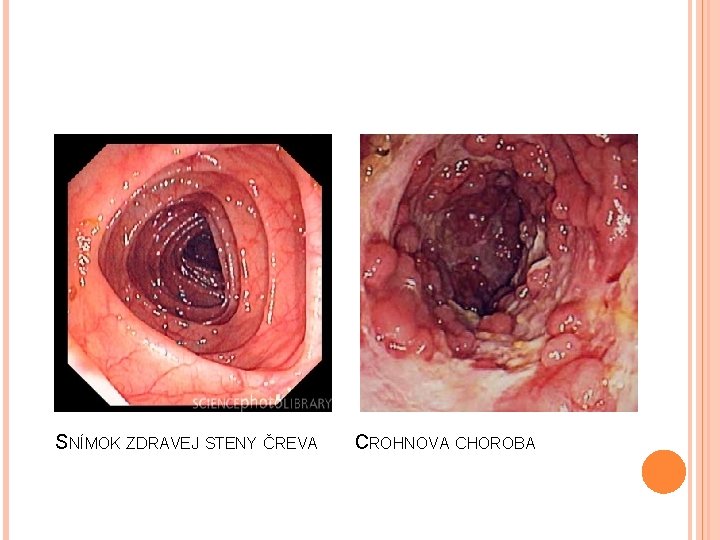 SNÍMOK ZDRAVEJ STENY ČREVA CROHNOVA CHOROBA 