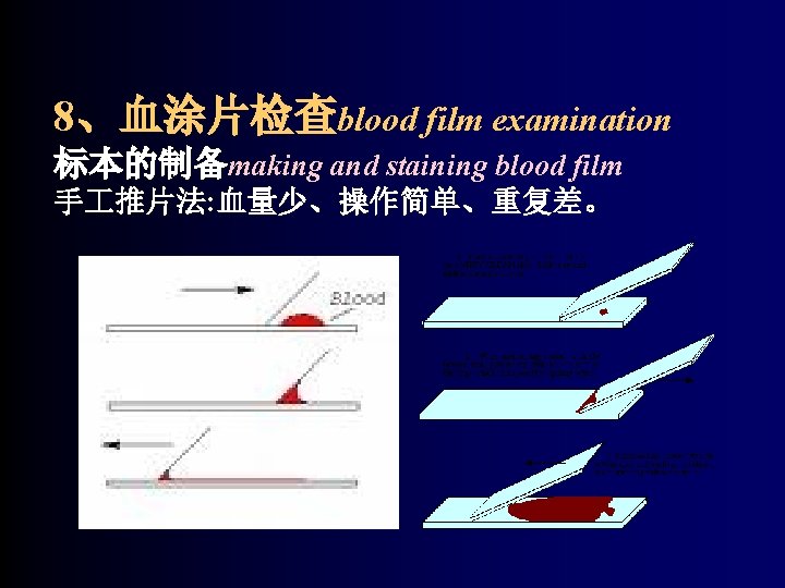 8、血涂片检查blood film examination 标本的制备making and staining blood film 手 推片法: 血量少、操作简单、重复差。 