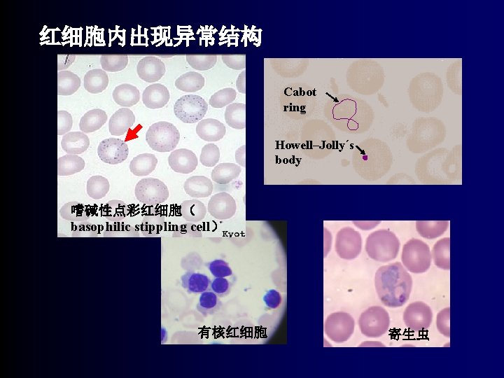 红细胞内出现异常结构 Cabot ring Howell–Jollyˊs body 嗜碱性点彩红细胞（ basophilic stippling cell） 有核红细胞 寄生虫 