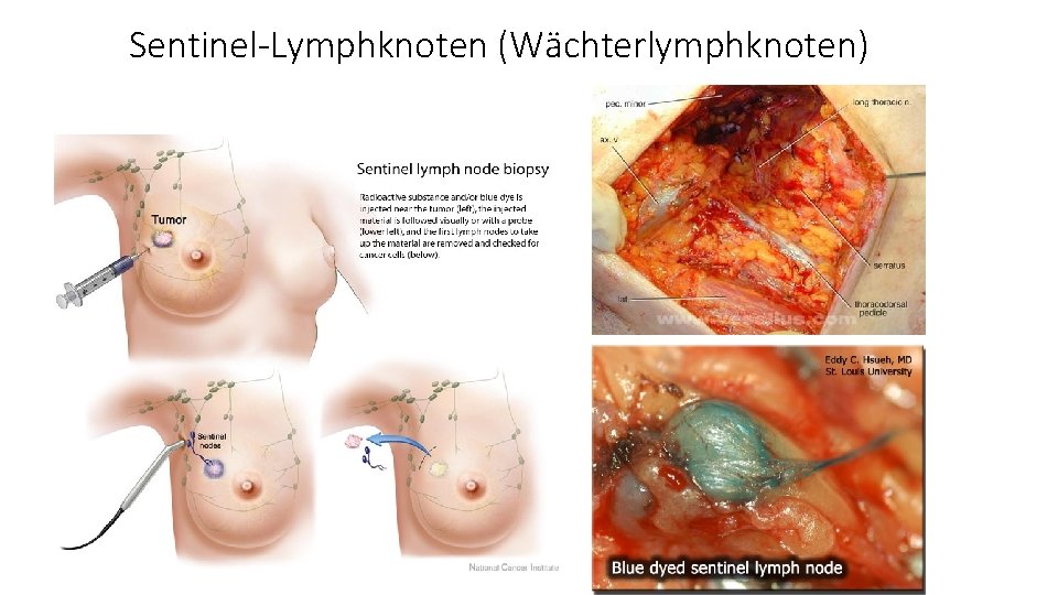 Sentinel-Lymphknoten (Wächterlymphknoten) 