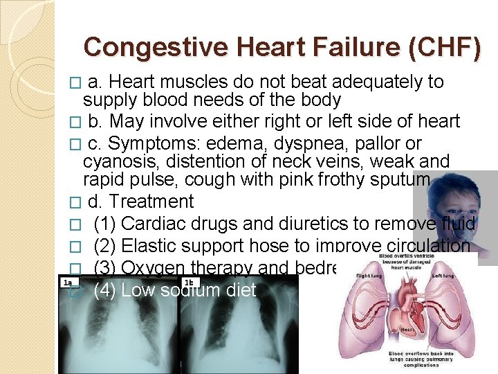 Congestive Heart Failure (CHF) a. Heart muscles do not beat adequately to supply blood