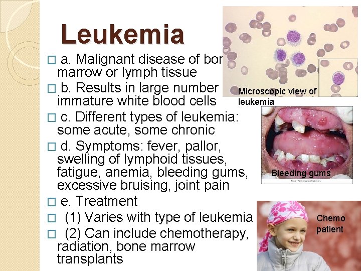 Leukemia a. Malignant disease of bone marrow or lymph tissue � b. Results in