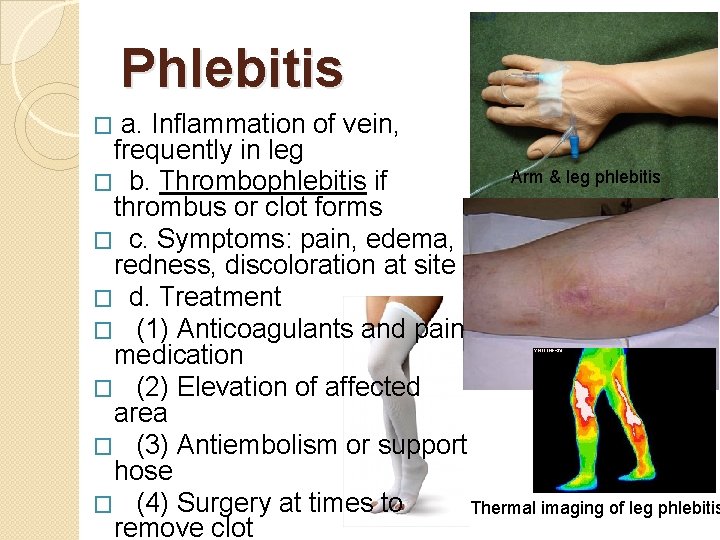 Phlebitis a. Inflammation of vein, frequently in leg Arm & leg phlebitis � b.