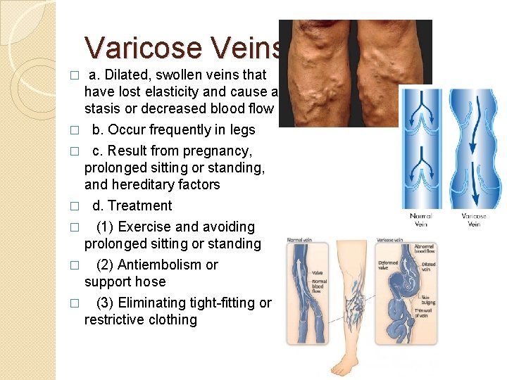 Varicose Veins a. Dilated, swollen veins that have lost elasticity and cause a stasis