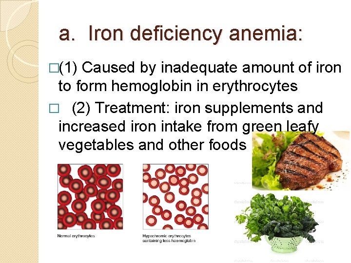 a. Iron deficiency anemia: �(1) Caused by inadequate amount of iron to form hemoglobin