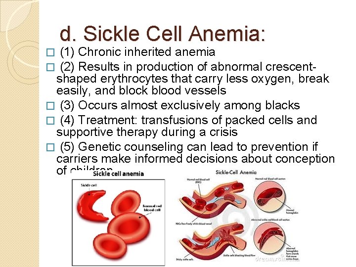 d. Sickle Cell Anemia: (1) Chronic inherited anemia (2) Results in production of abnormal