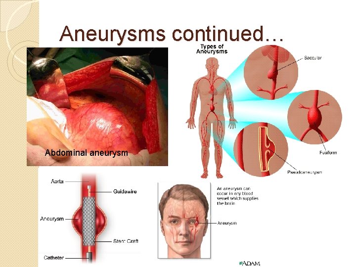 Aneurysms continued… Abdominal aneurysm 