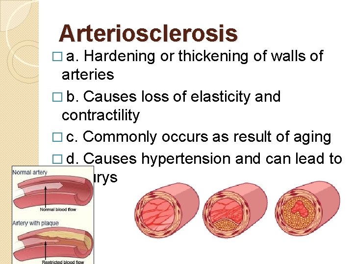 Arteriosclerosis � a. Hardening or thickening of walls of arteries � b. Causes loss