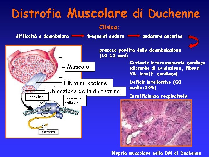 Distrofia Muscolare di Duchenne Clinica: difficoltà a deambulare frequenti cadute Muscolo Proteina precoce perdita