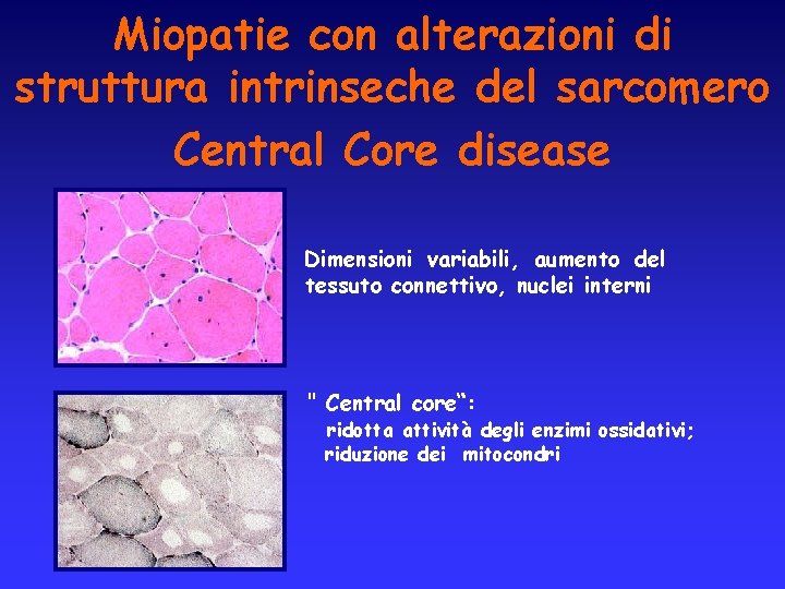 Miopatie con alterazioni di struttura intrinseche del sarcomero Central Core disease Dimensioni variabili, aumento