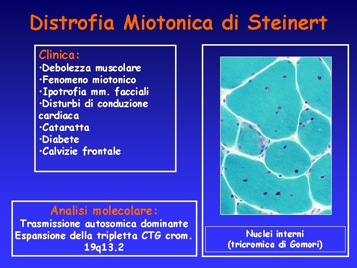 Distrofia Miotonica di Steinert Clinica: • Debolezza muscolare • Fenomeno miotonico • Ipotrofia mm.
