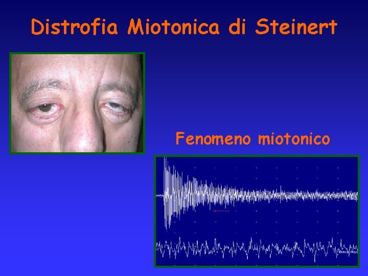 Distrofia Miotonica di Steinert Fenomeno miotonico 