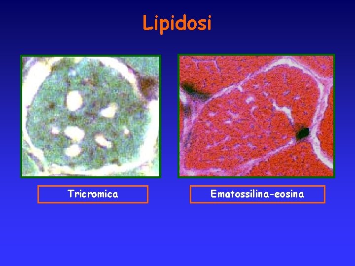 Lipidosi Tricromica Ematossilina-eosina 