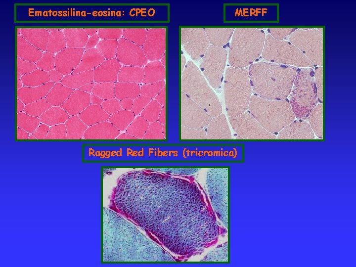 Ematossilina-eosina: CPEO MERFF Ragged Red Fibers (tricromica) 