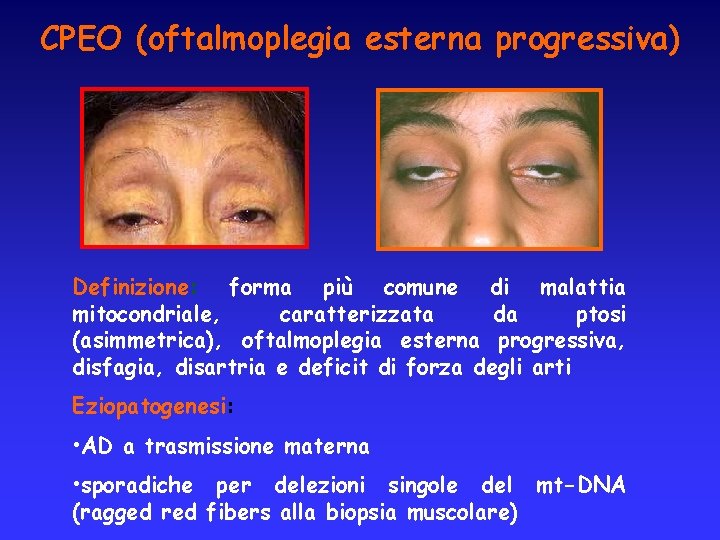CPEO (oftalmoplegia esterna progressiva) Definizione: forma più comune di malattia mitocondriale, caratterizzata da ptosi