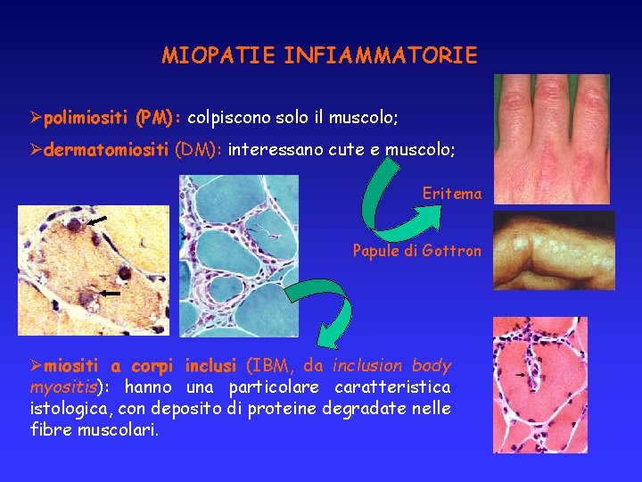 MIOPATIE INFIAMMATORIE Øpolimiositi (PM): colpiscono solo il muscolo; Ødermatomiositi (DM): interessano cute e muscolo;