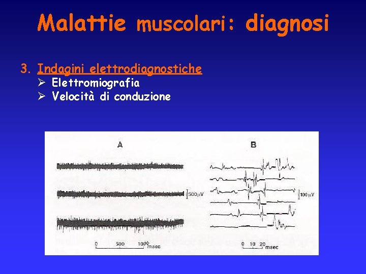 Malattie muscolari: diagnosi 3. Indagini elettrodiagnostiche Ø Elettromiografia Ø Velocità di conduzione 