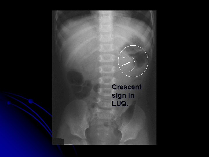 Crescent sign in LUQ. 