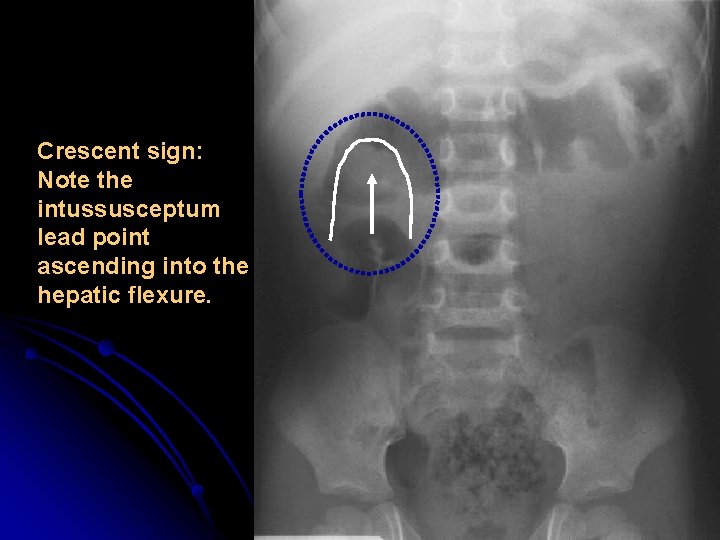 Crescent sign: Note the intussusceptum lead point ascending into the hepatic flexure. 