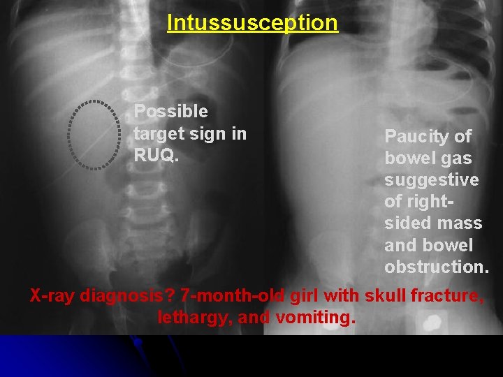 Intussusception Possible target sign in RUQ. Paucity of bowel gas suggestive of rightsided mass