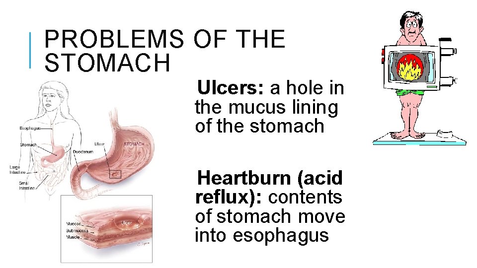 PROBLEMS OF THE STOMACH Ulcers: a hole in the mucus lining of the stomach