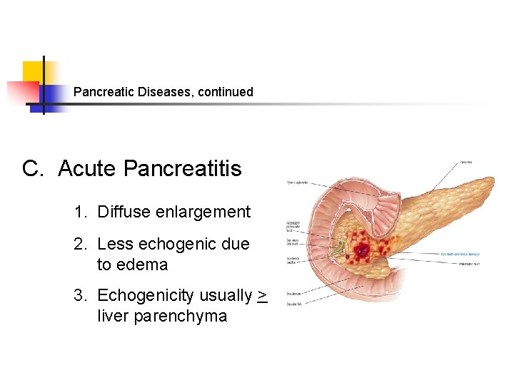 Pancreatic Diseases, continued C. Acute Pancreatitis 1. Diffuse enlargement 2. Less echogenic due to