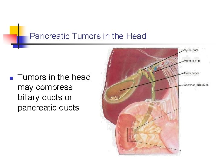 Pancreatic Tumors in the Head n Tumors in the head may compress biliary ducts