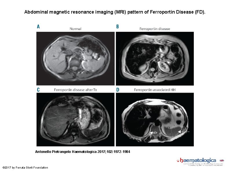 Abdominal magnetic resonance imaging (MRI) pattern of Ferroportin Disease (FD). Antonello Pietrangelo Haematologica 2017;