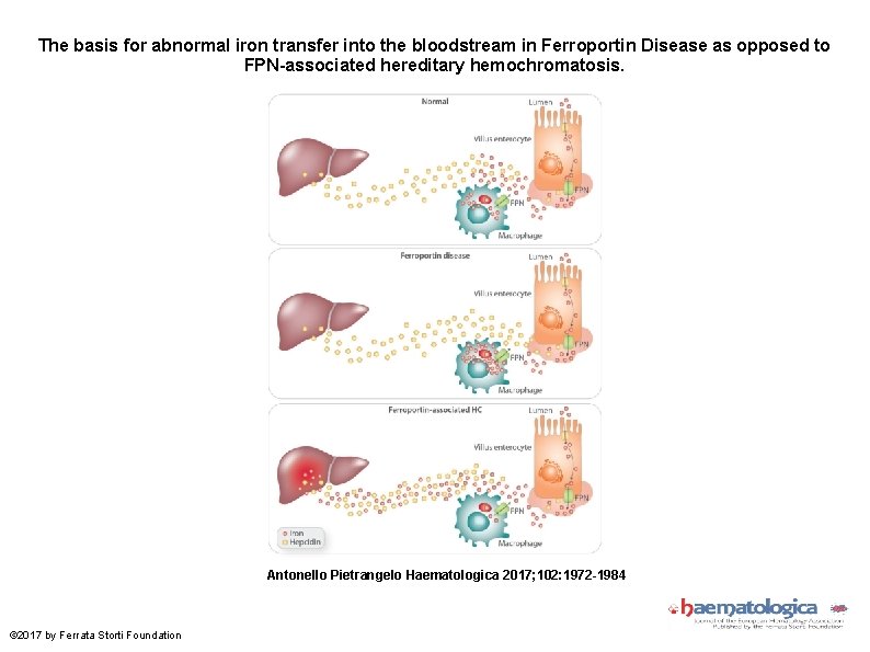 The basis for abnormal iron transfer into the bloodstream in Ferroportin Disease as opposed