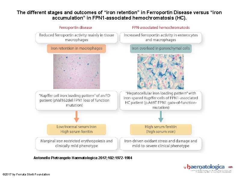 The different stages and outcomes of “iron retention” in Ferroportin Disease versus “iron accumulation”