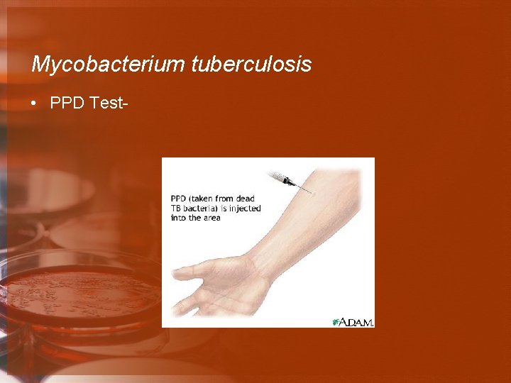 Mycobacterium tuberculosis • PPD Test- 