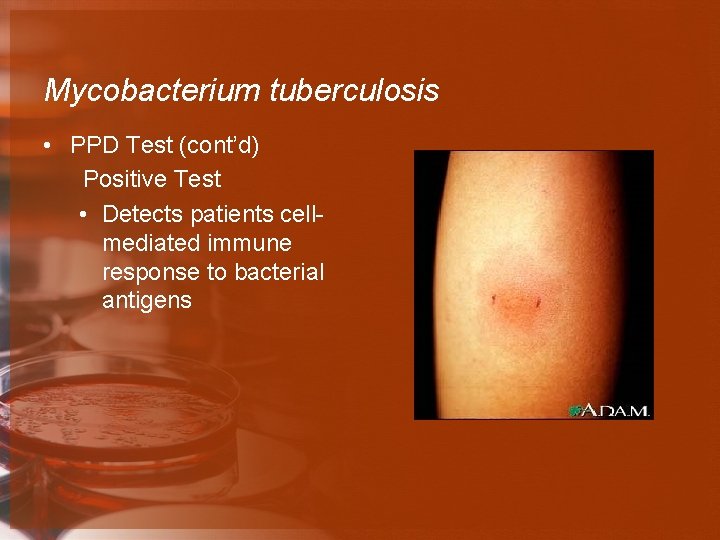 Mycobacterium tuberculosis • PPD Test (cont’d) Positive Test • Detects patients cellmediated immune response