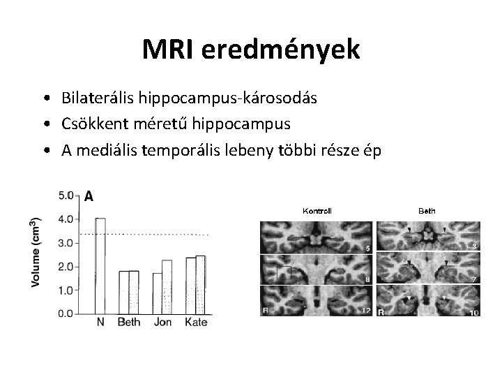 MRI eredmények • Bilaterális hippocampus-károsodás • Csökkent méretű hippocampus • A mediális temporális lebeny