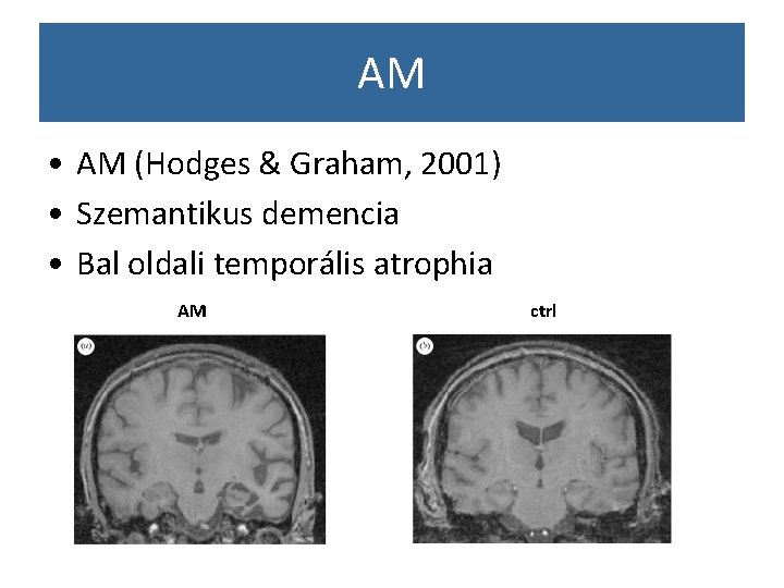 AM • AM (Hodges & Graham, 2001) • Szemantikus demencia • Bal oldali temporális