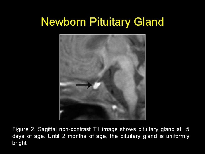 Newborn Pituitary Gland Figure 2. Sagittal non-contrast T 1 image shows pituitary gland at