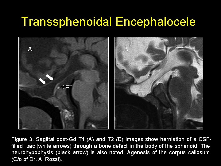 Transsphenoidal Encephalocele A B Figure 3. Sagittal post-Gd T 1 (A) and T 2