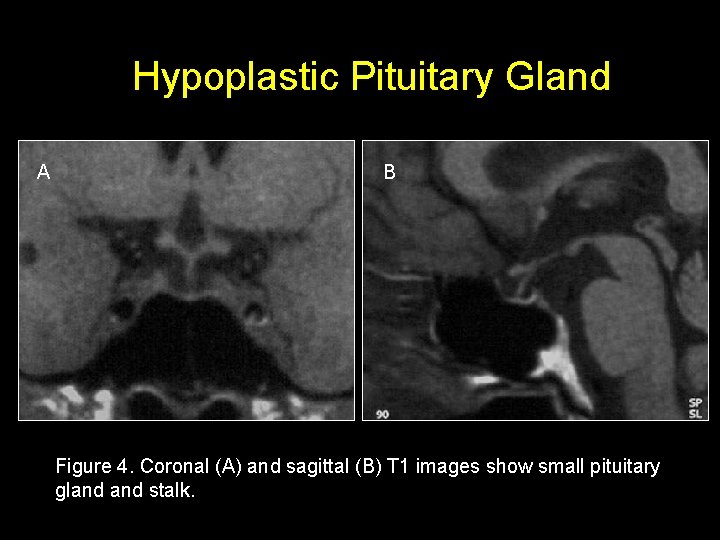 Hypoplastic Pituitary Gland A B Figure 4. Coronal (A) and sagittal (B) T 1