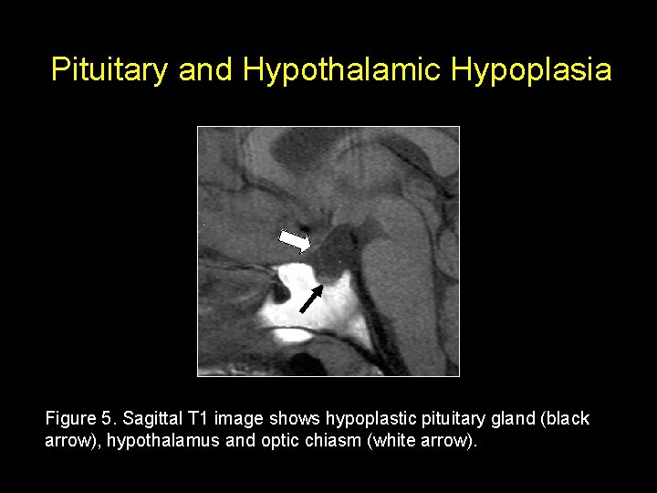 Pituitary and Hypothalamic Hypoplasia Figure 5. Sagittal T 1 image shows hypoplastic pituitary gland