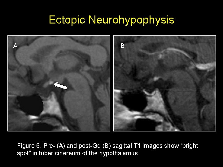 Ectopic Neurohypophysis A B Figure 6. Pre- (A) and post-Gd (B) sagittal T 1