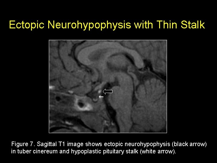 Ectopic Neurohypophysis with Thin Stalk Figure 7. Sagittal T 1 image shows ectopic neurohypophysis