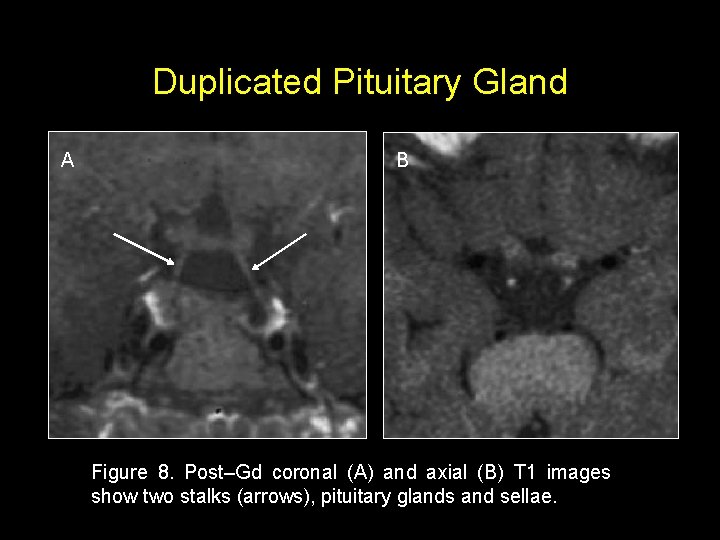 Duplicated Pituitary Gland A B Figure 8. Post–Gd coronal (A) and axial (B) T
