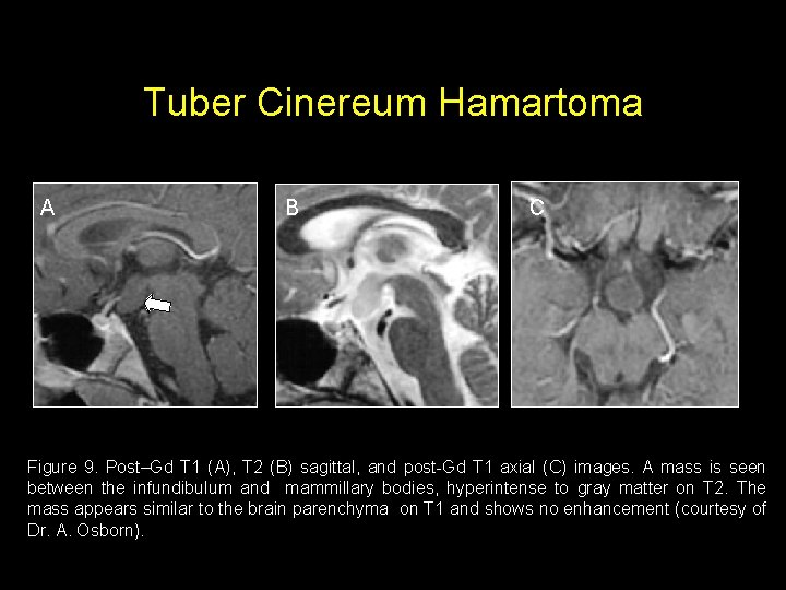 Tuber Cinereum Hamartoma A B C Figure 9. Post–Gd T 1 (A), T 2
