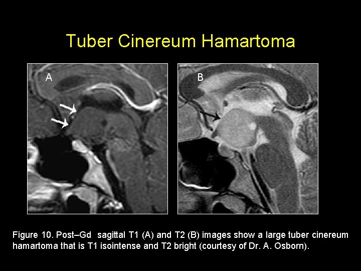 Tuber Cinereum Hamartoma A B Figure 10. Post–Gd sagittal T 1 (A) and T