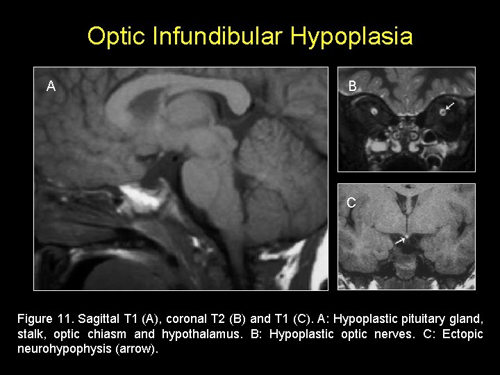 Optic Infundibular Hypoplasia A B C Figure 11. Sagittal T 1 (A), coronal T