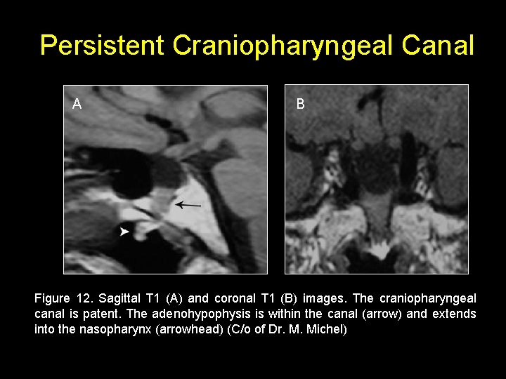 Persistent Craniopharyngeal Canal A B Figure 12. Sagittal T 1 (A) and coronal T