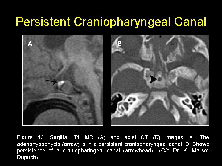 Persistent Craniopharyngeal Canal A B Figure 13. Sagittal T 1 MR (A) and axial