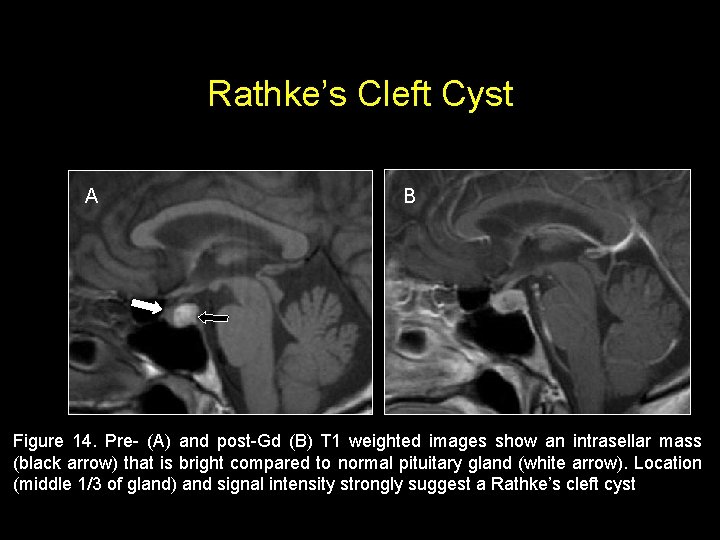 Rathke’s Cleft Cyst A B Figure 14. Pre- (A) and post-Gd (B) T 1